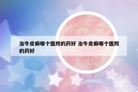 治牛皮癬哪個醫(yī)院的藥好 治牛皮癬哪個醫(yī)院的藥好