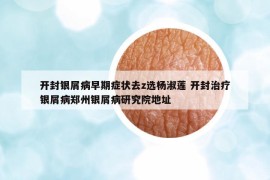 開封銀屑病早期癥狀去z選楊淑蓮 開封治療銀屑病鄭州銀屑病研究院地址