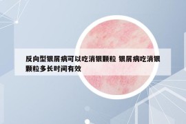 反向型銀屑病可以吃消銀顆粒 銀屑病吃消銀顆粒多長時間有效