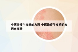 中醫(yī)治療牛皮癬的方藥 中醫(yī)治療牛皮癬的方藥有哪些