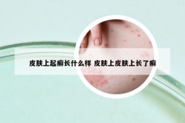 皮膚上起癬長什么樣 皮膚上皮膚上長了癬