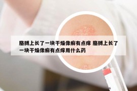 胳膊上長了一塊干燥像癬有點(diǎn)癢 胳膊上長了一塊干燥像癬有點(diǎn)癢用什么藥