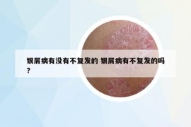 銀屑病有沒有不復(fù)發(fā)的 銀屑病有不復(fù)發(fā)的嗎?