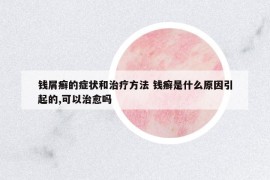 錢屑癬的癥狀和治療方法 錢癬是什么原因引起的,可以治愈嗎