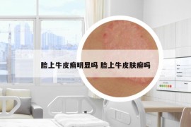 臉上牛皮癬明顯嗎 臉上牛皮膚癬嗎