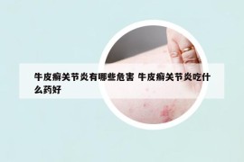 牛皮癬關(guān)節(jié)炎有哪些危害 牛皮癬關(guān)節(jié)炎吃什么藥好