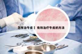 怎樣治牛皮廯 有效治療牛皮的方法