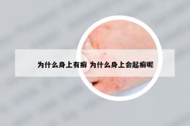 為什么身上有癬 為什么身上會(huì)起癬呢