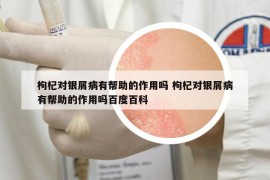 枸杞對銀屑病有幫助的作用嗎 枸杞對銀屑病有幫助的作用嗎百度百科