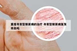 重度尋常型銀屑病的治療 尋常型銀屑病復(fù)發(fā)率高嗎