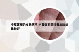 寧夏正規(guī)的皮膚醫(yī)院 寧夏哪家醫(yī)院看皮膚病比較好