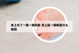 身上長了一圈一圈的蘚 身上起一圈癬是什么原因