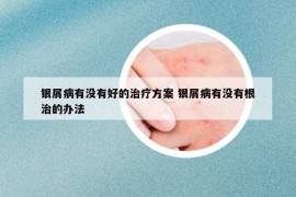 銀屑病有沒有好的治療方案 銀屑病有沒有根治的辦法