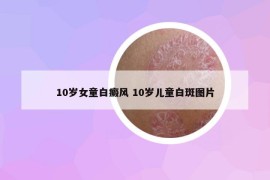 10歲女童白癜風(fēng) 10歲兒童白斑圖片