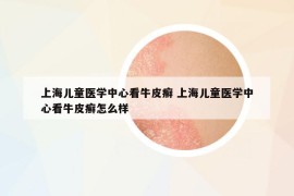 上海兒童醫(yī)學(xué)中心看牛皮癬 上海兒童醫(yī)學(xué)中心看牛皮癬怎么樣