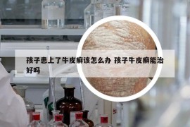 孩子患上了牛皮癬該怎么辦 孩子牛皮癬能治好嗎