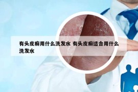 有頭皮癬用什么洗發(fā)水 有頭皮癬適合用什么洗發(fā)水