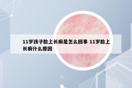 11歲孩子臉上長(zhǎng)癬是怎么回事 11歲臉上長(zhǎng)癬什么原因