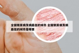 全國銀屑病發(fā)病最低的城市 全國銀屑病發(fā)病最低的城市是哪里