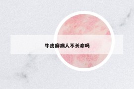 牛皮癬病人不長命嗎