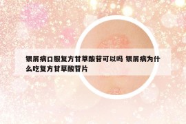 銀屑病口服復(fù)方甘草酸苷可以嗎 銀屑病為什么吃復(fù)方甘草酸苷片