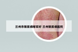 蘭州市銀屑病哪家好 蘭州銀屑病醫(yī)院