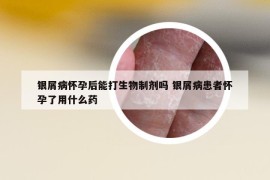 銀屑病懷孕后能打生物制劑嗎 銀屑病患者懷孕了用什么藥