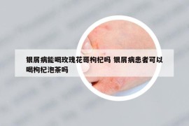 銀屑病能喝玫瑰花哥枸杞嗎 銀屑病患者可以喝枸杞泡茶嗎