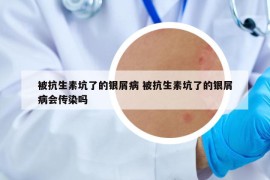 被抗生素坑了的銀屑病 被抗生素坑了的銀屑病會(huì)傳染嗎