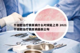干細(xì)胞治療銀屑病什么時候能上市 2021干細(xì)胞治療銀屑病最新公布