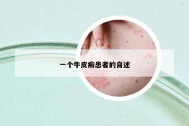 一個(gè)牛皮癬患者的自述