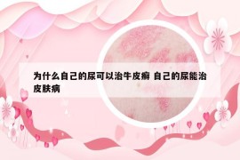為什么自己的尿可以治牛皮癬 自己的尿能治皮膚病