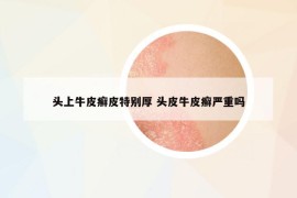 頭上牛皮癬皮特別厚 頭皮牛皮癬嚴(yán)重嗎