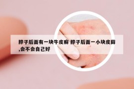 脖子后面有一塊牛皮癬 脖子后面一小塊皮蘚,會(huì)不會(huì)自己好