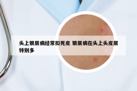 頭上銀屑病經(jīng)?？鬯榔?銀屑病在頭上頭皮屑特別多