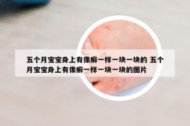 五個(gè)月寶寶身上有像癬一樣一塊一塊的 五個(gè)月寶寶身上有像癬一樣一塊一塊的圖片
