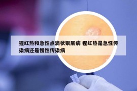 猩紅熱和急性點滴狀銀屑病 猩紅熱是急性傳染病還是慢性傳染病