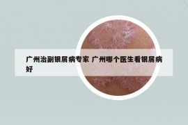 廣州治副銀屑病專家 廣州哪個醫(yī)生看銀屑病好