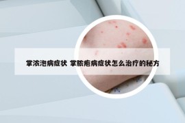 掌濃泡病癥狀 掌膿皰病癥狀怎么治療的秘方