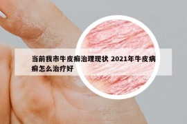 當(dāng)前我市牛皮癬治理現(xiàn)狀 2021年牛皮病癬怎么治療好