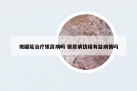 拔罐能治療銀屑病嗎 銀屑病拔罐有益病情嗎