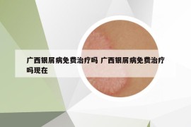 廣西銀屑病免費治療嗎 廣西銀屑病免費治療嗎現(xiàn)在