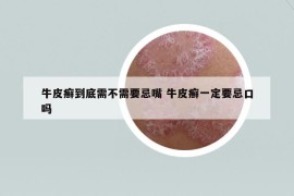 牛皮癬到底需不需要忌嘴 牛皮癬一定要忌口嗎