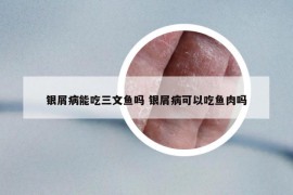 銀屑病能吃三文魚嗎 銀屑病可以吃魚肉嗎