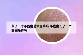 長了一個(gè)小疙瘩是銀屑病嗎 小疙瘩長了一個(gè)圓圈是蘚嗎
