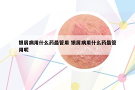 銀屑病用什么藥最管用 銀屑病用什么藥最管用呢