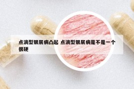 點(diǎn)滴型銀屑病凸起 點(diǎn)滴型銀屑病是不是一個(gè)很硬