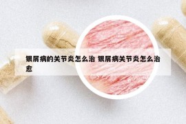 銀屑病的關(guān)節(jié)炎怎么治 銀屑病關(guān)節(jié)炎怎么治愈