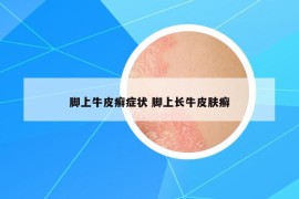 腳上牛皮癬癥狀 腳上長牛皮膚癬