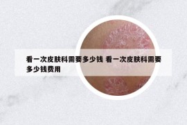 看一次皮膚科需要多少錢 看一次皮膚科需要多少錢費(fèi)用